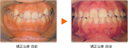 矯正治療 術前・術後