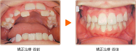 矯正治療 術前・術後