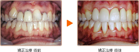 矯正治療 術前・術後