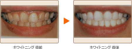 ホワイトニング 術前・術後