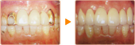 セラミック・クラウン 術前・術後