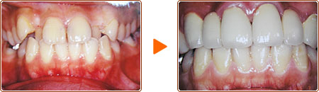 MTM（小矯正治療） 術前・術後