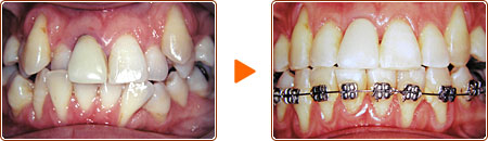 MTM（小矯正治療） 術前・術後